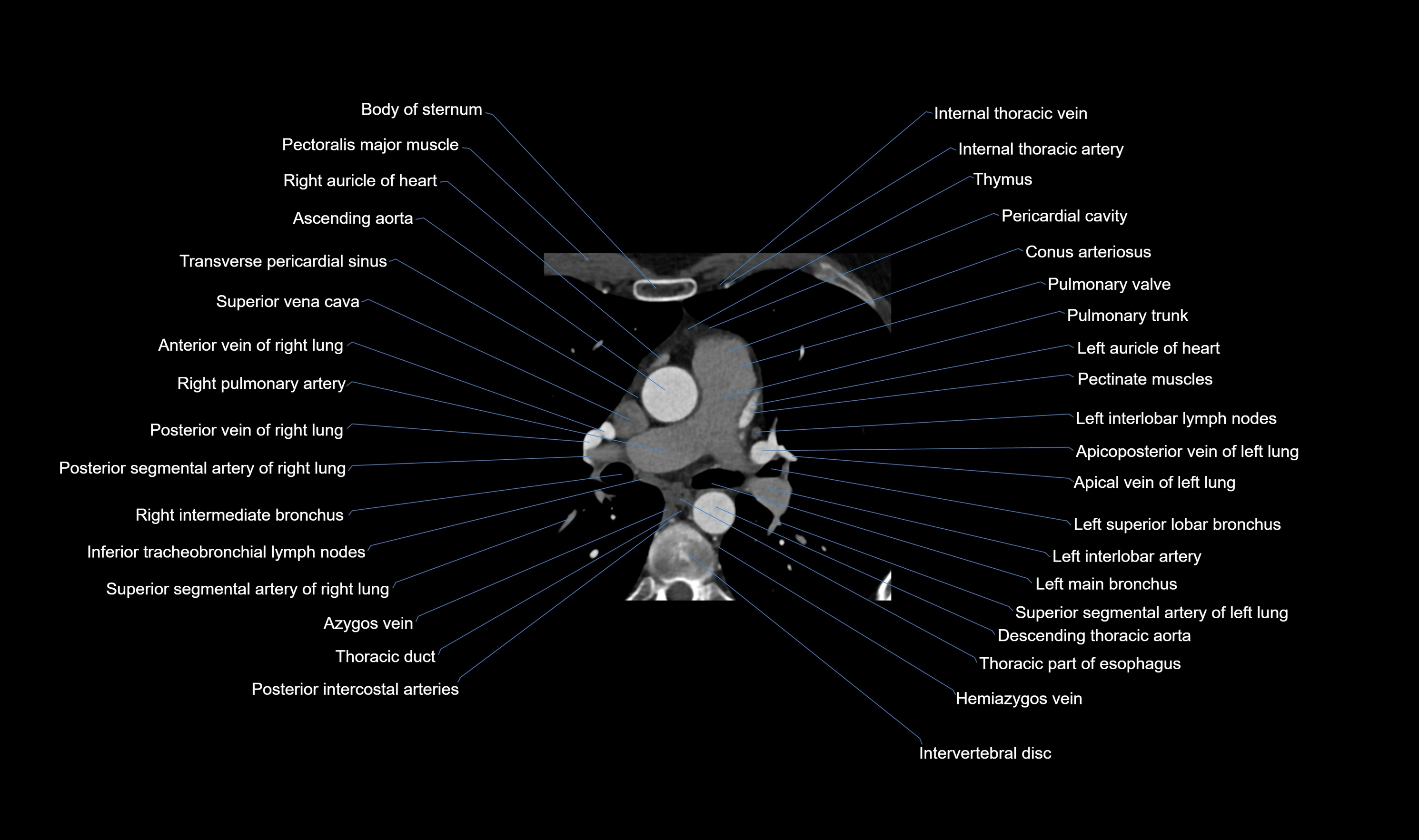CT heart (coronary angiogram) axial view cross sectional anatomy labelled radiology image-00015.webp